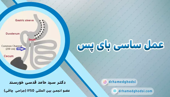 عمل ساسی بای پس معده