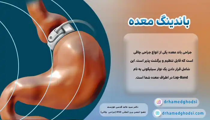 عمل باندینگ معده