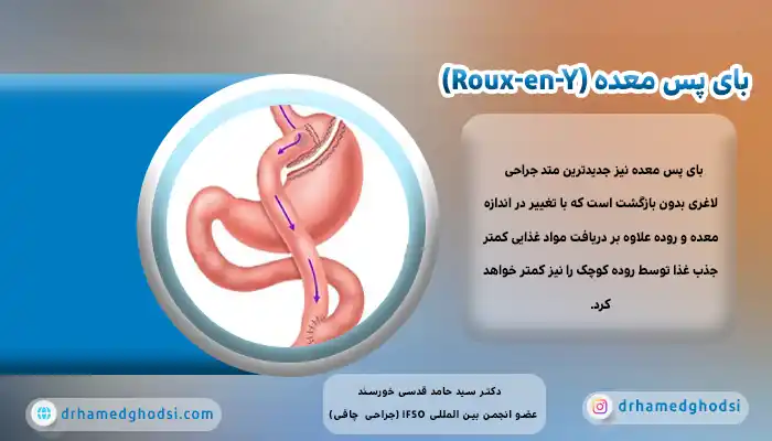 عمل بای پس معده
