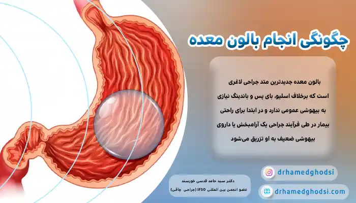 بالون معده