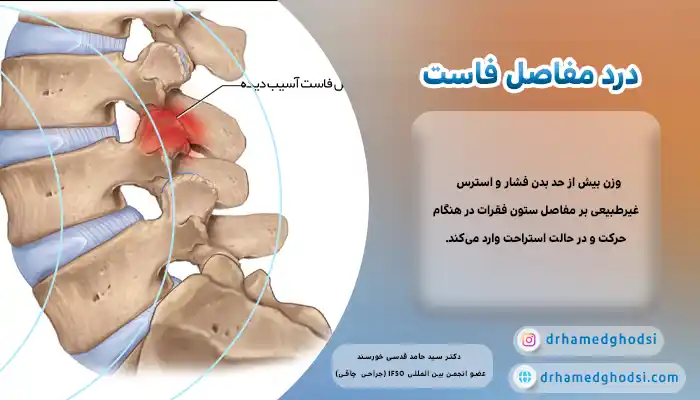 درد مفاصل فاست