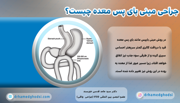 جراحی مینی بای پس معده چیست؟ 
