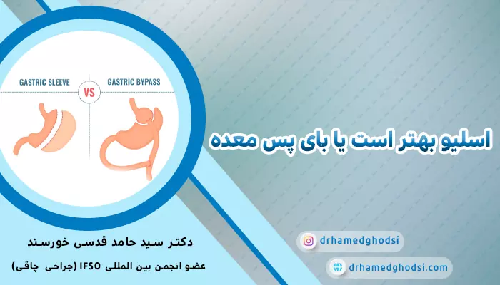 بای پس معده بهتر است یا اسلیو