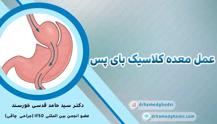 بای پس کلاسیک معده
