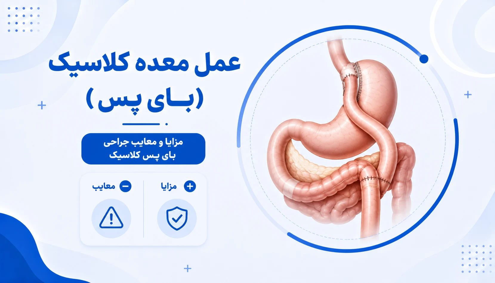عمل معده کلاسیک بای پس