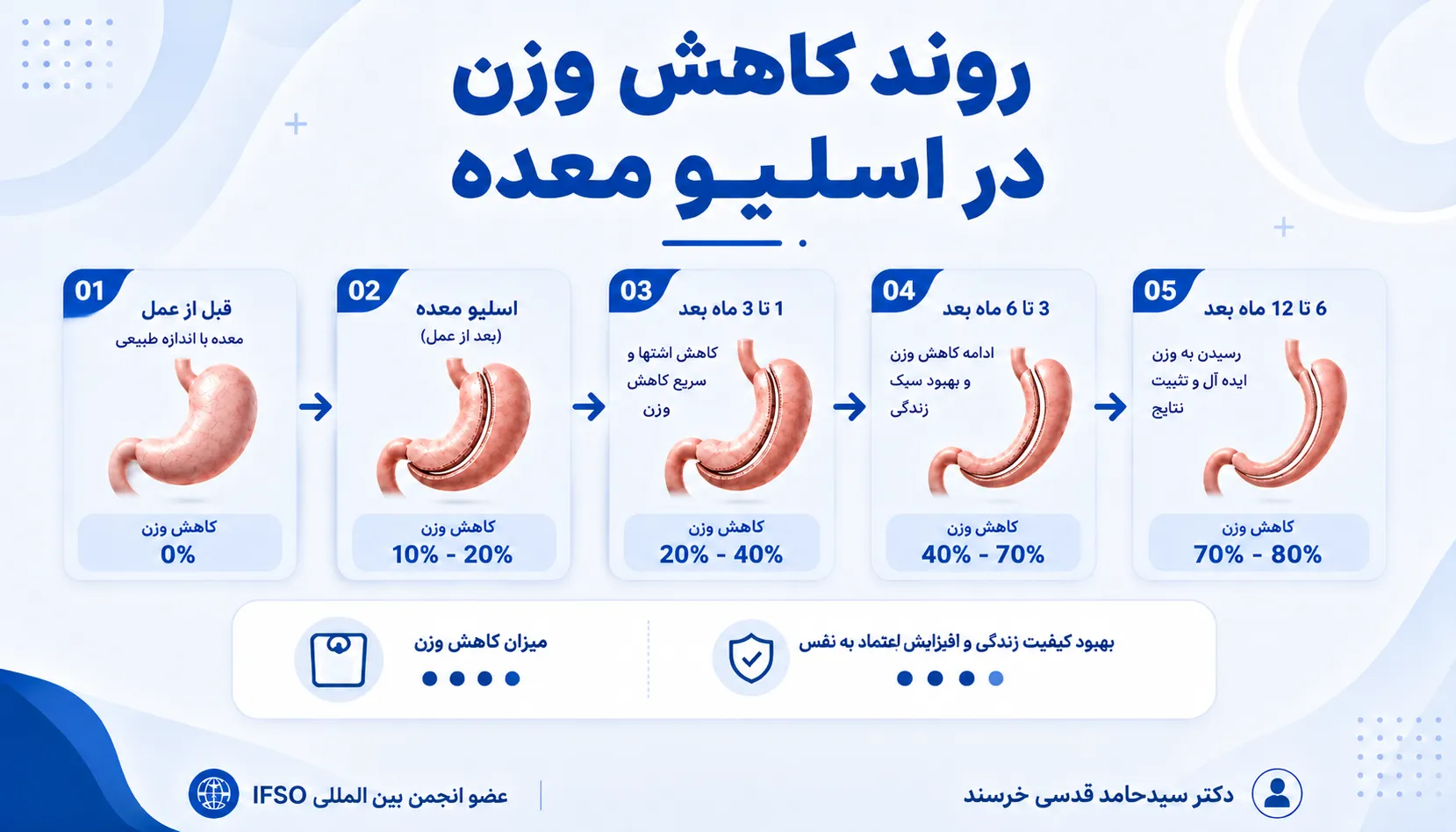 روند کاهش وزن در جراحی اسلیو معده و چاقی